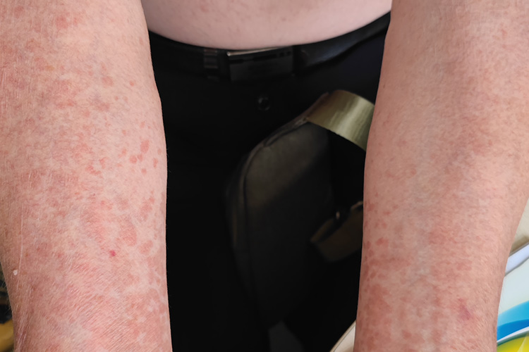 花斑癣圆形红斑图