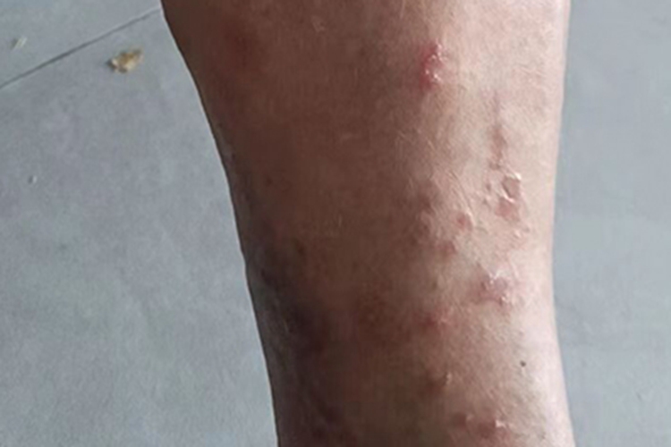 慢性湿疹腿上起小疙瘩图