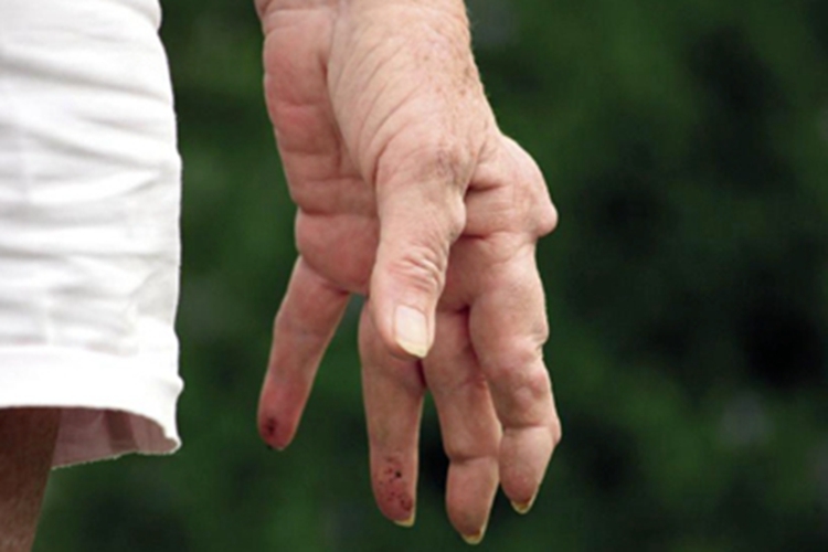 费尔蒂综合征骨畸形症状图 费尔蒂综合征骨畸形症状图