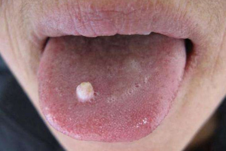 尖锐湿疣图 尖锐湿疣图