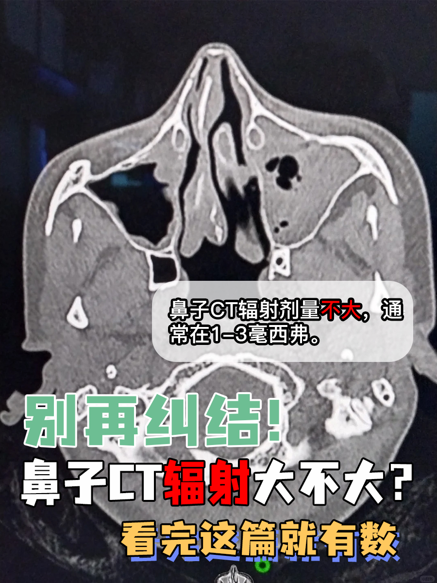 别再纠结！鼻子CT辐射大不大？看完这篇就有数