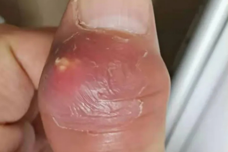 急性痛风性关节炎图 急性痛风性关节炎图