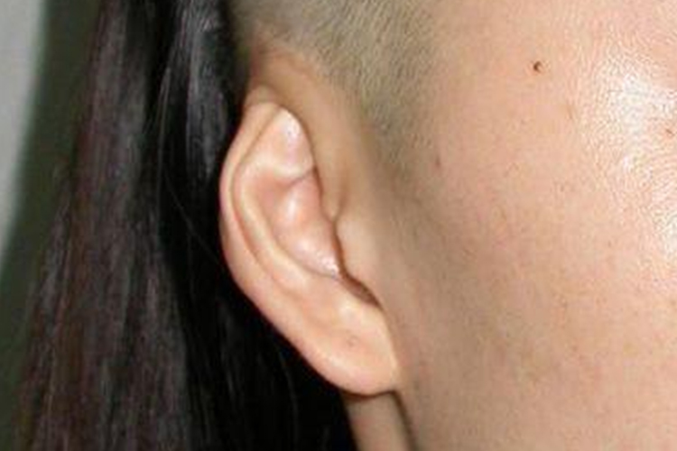 隐耳畸形图