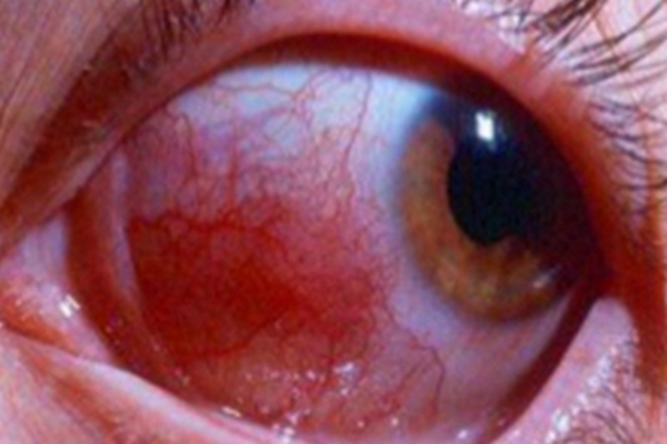红眼病眼部红斑图