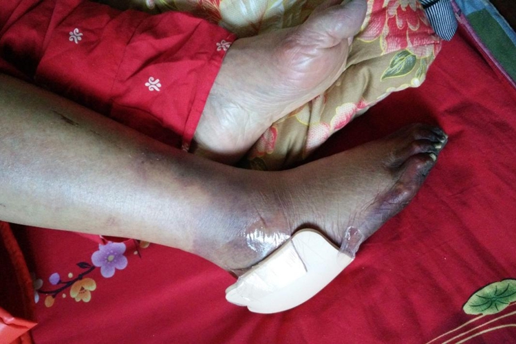 孕妇下肢静脉血栓症状图