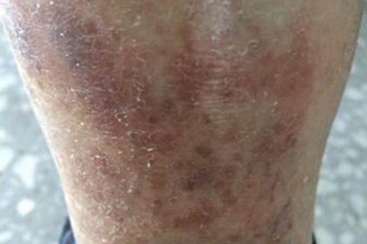 淤积性皮炎症状图