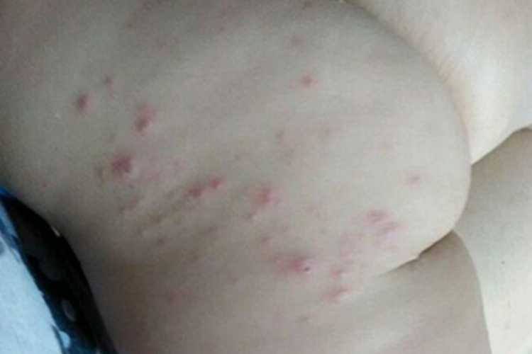 手足口病臀部疱疹图 手足口病臀部疱疹图