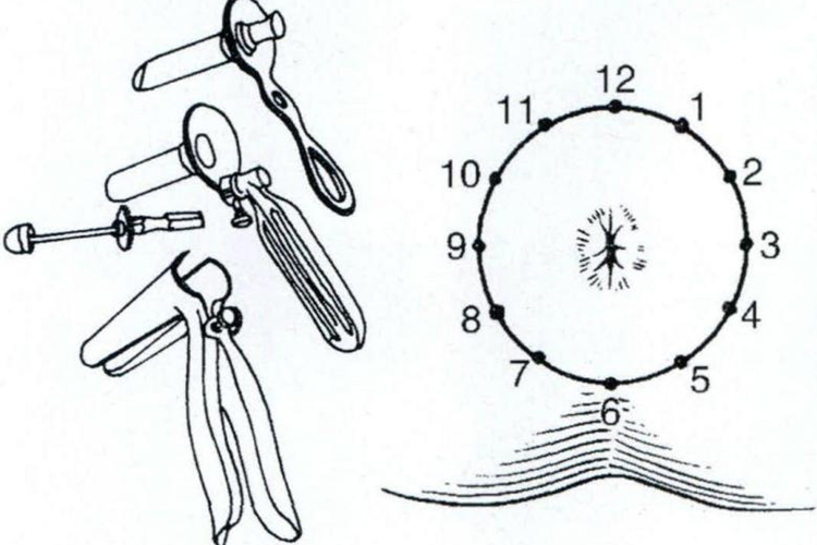 截石位痔疮12点分法图 截石位痔疮12点分法图