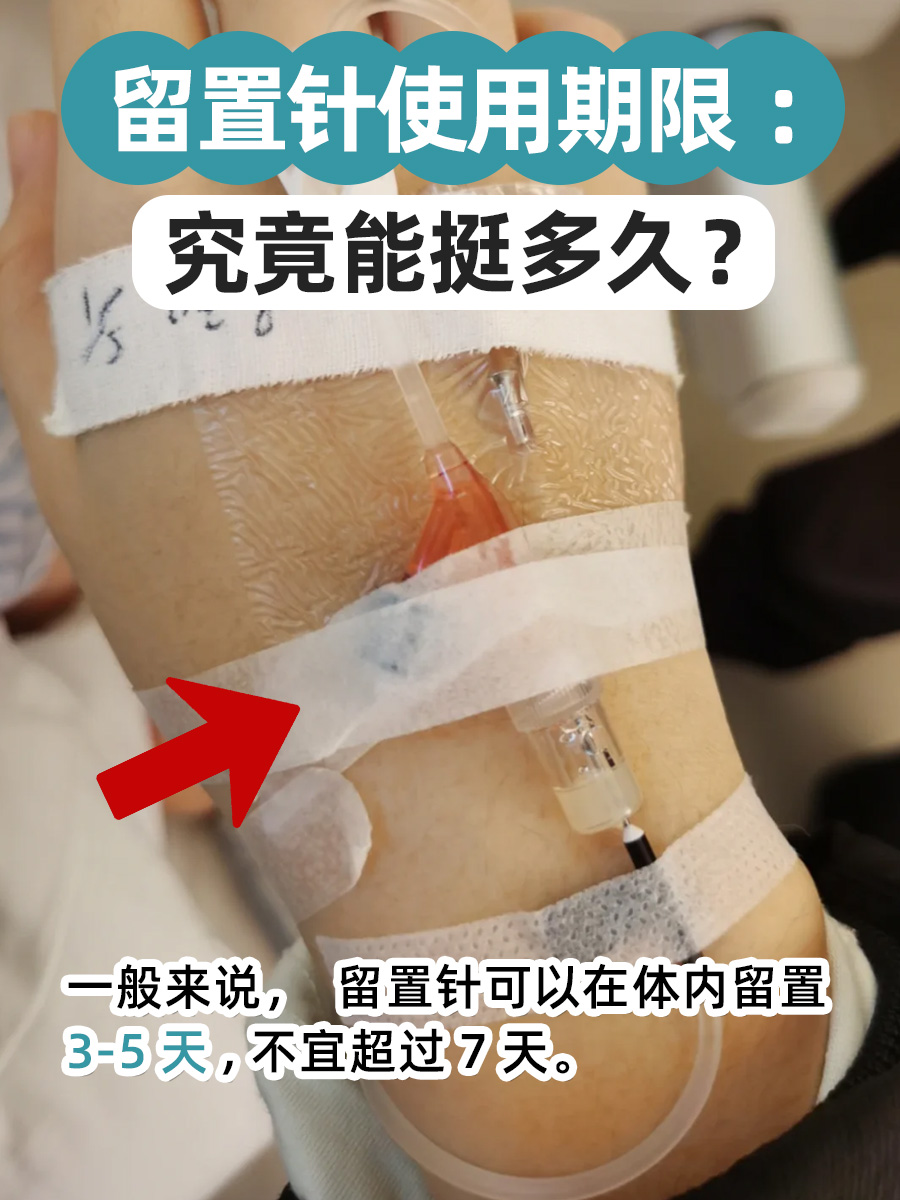 留置针使用期限：究竟能挺多久？