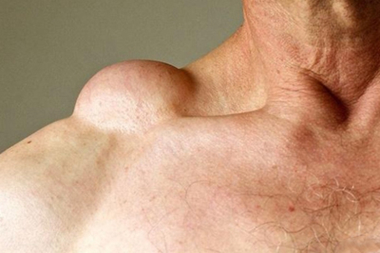 浅表血管黏液瘤肩部肿块图 浅表血管黏液瘤肩部肿块图