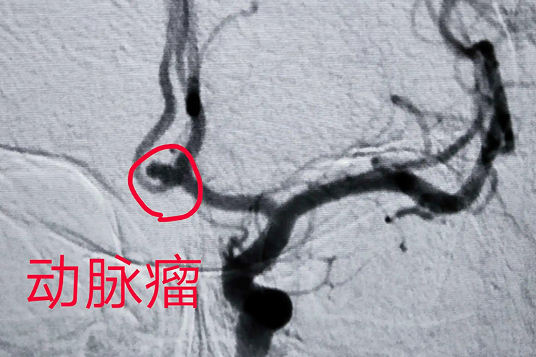 颅内动脉瘤图 颅内动脉瘤图