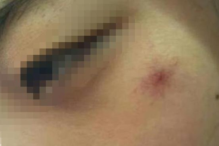 蜘蛛痣图 蜘蛛痣图