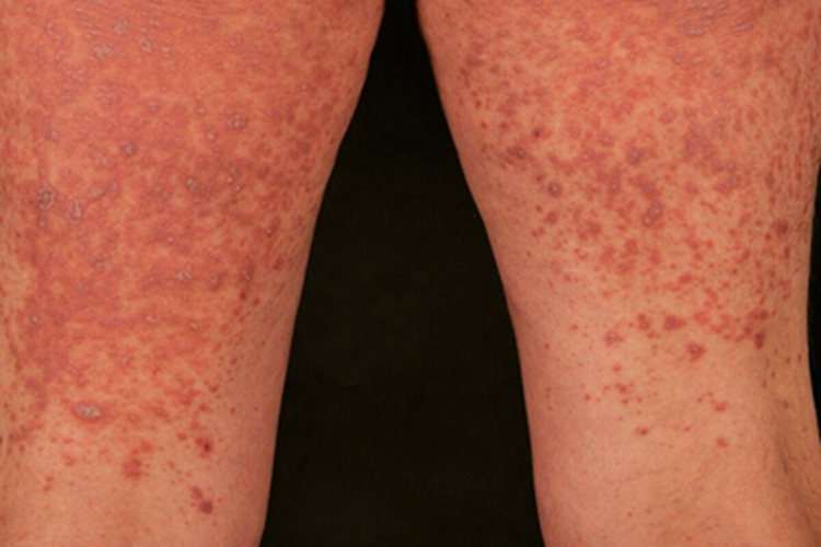 苔藓样念珠状疹丘疹图