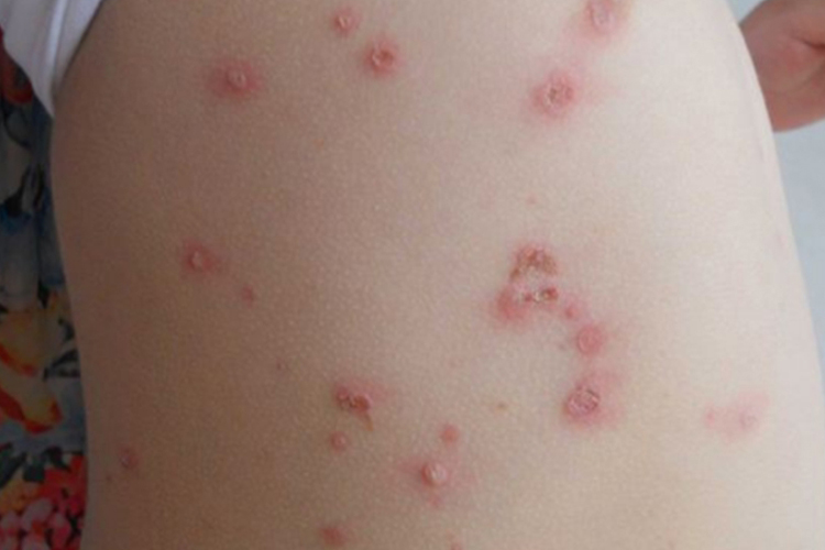 水痘肚子上长水疱图 水痘肚子上长水疱图