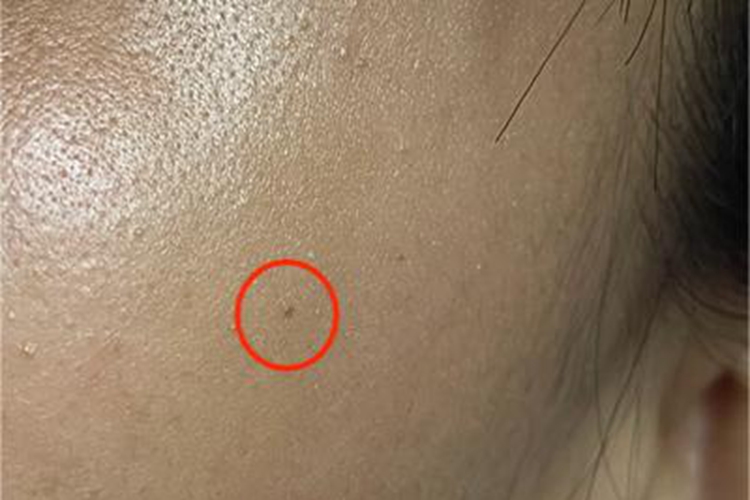 交界痣面部长斑图