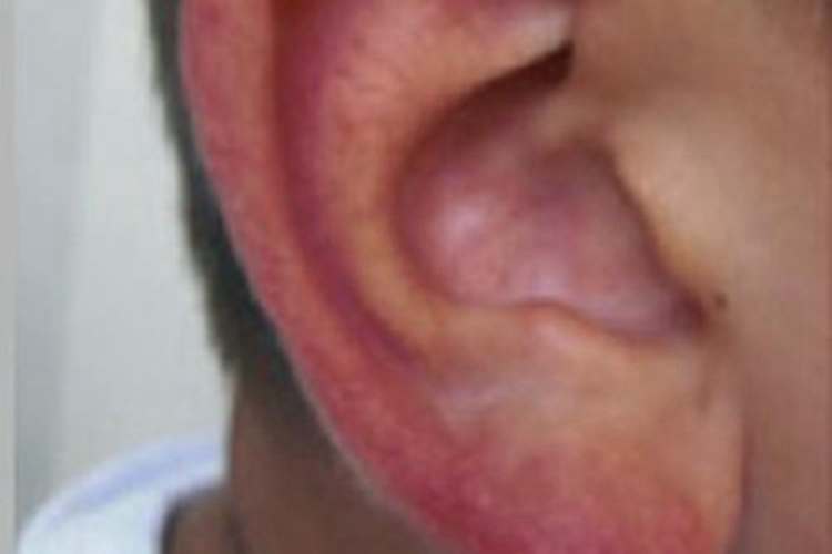 青少年春季疹耳部红肿图 青少年春季疹耳部红肿图