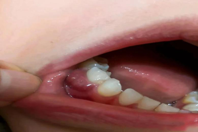 宝宝牙龈炎牙龈充血红肿图 宝宝牙龈炎牙龈充血红肿图