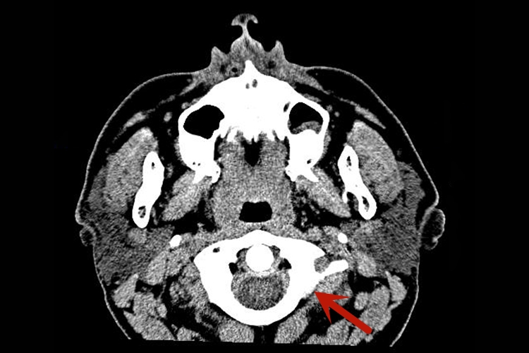 正常颌面部CT下颌骨图 正常颌面部CT下颌骨图