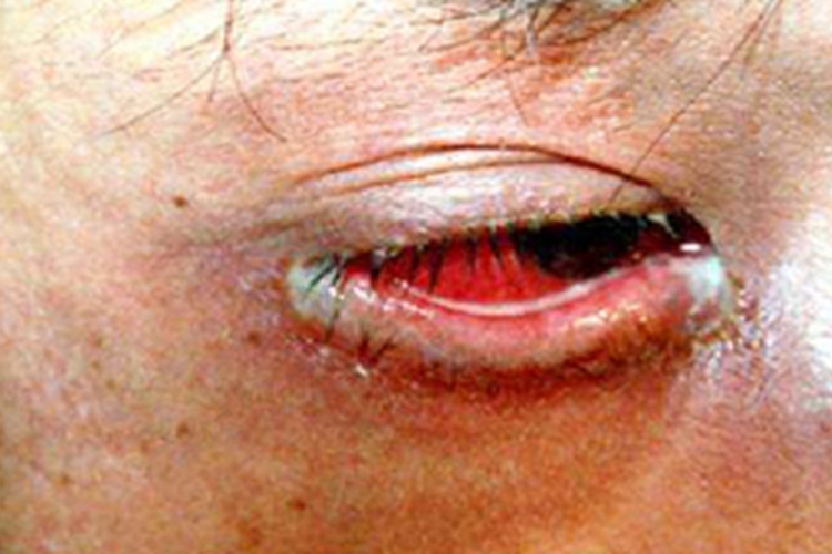 慢性泪囊炎充血图 慢性泪囊炎充血图