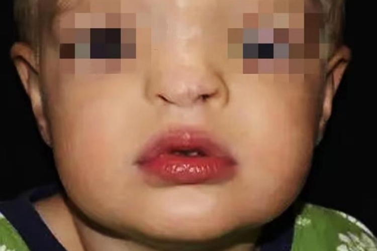 Williams综合征面容图