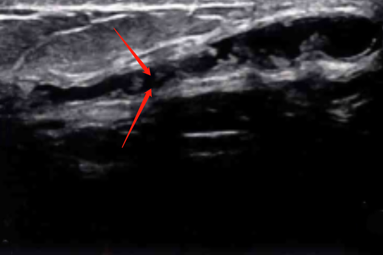 乳腺导管扩张Ⅰ型超声图