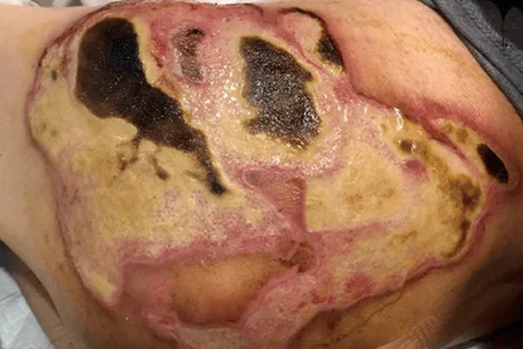 Ⅲ度烧伤结痂图