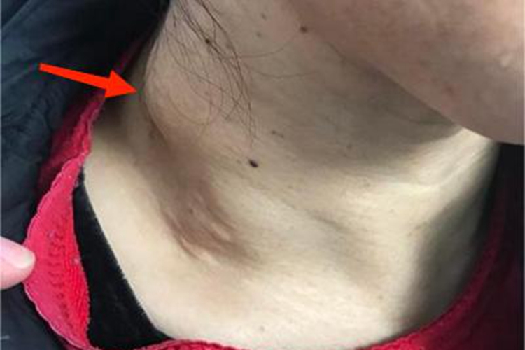 结节性甲状腺肿结节图 结节性甲状腺肿结节图