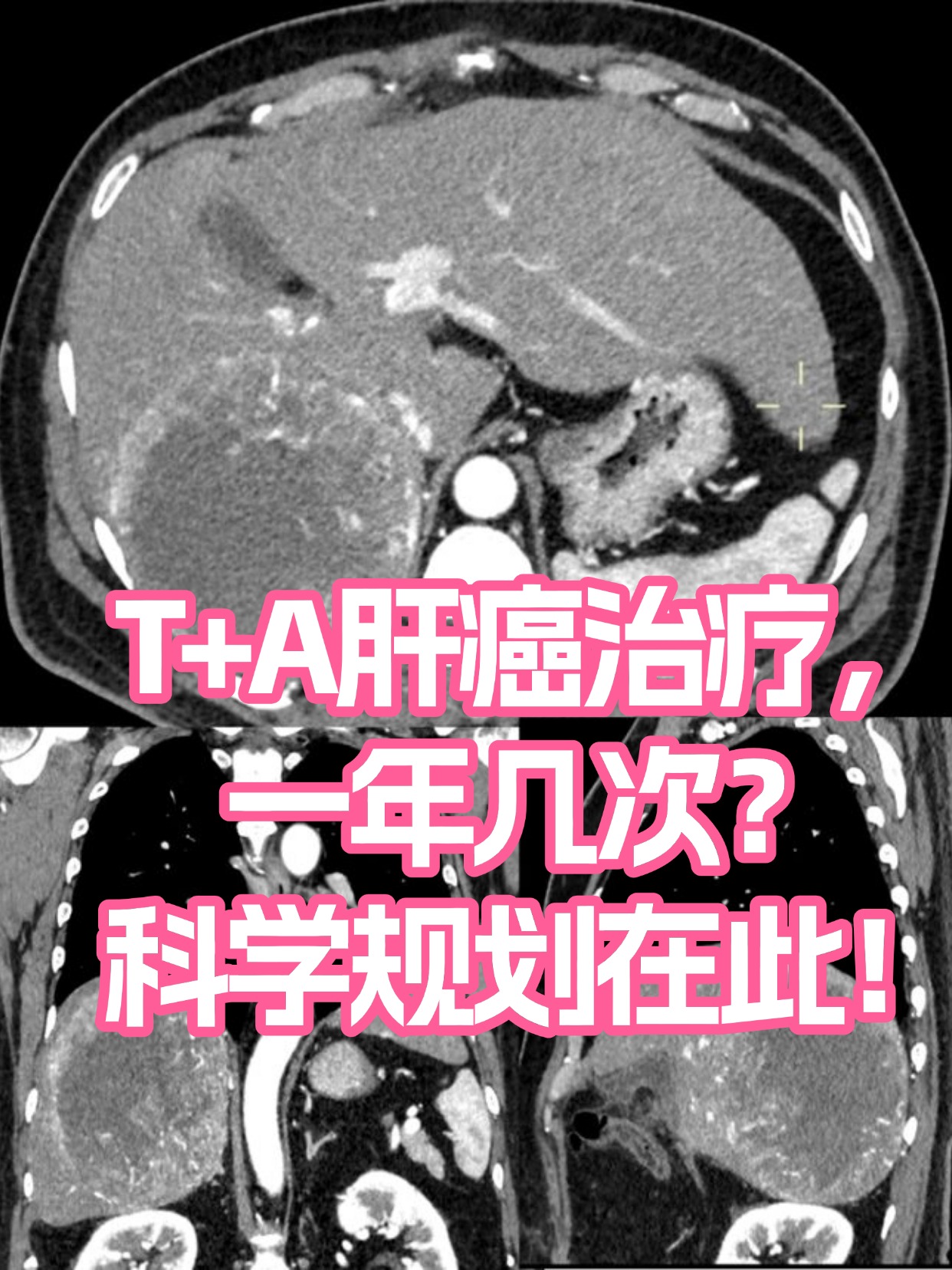 T+A肝癌治疗，一年几次？科学规划在此！
