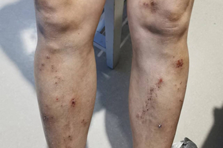 慢性湿疹小腿血痂图