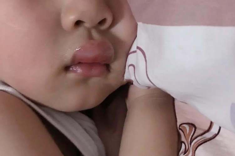 宝宝嘴唇被蚊子咬肿图 宝宝嘴唇被蚊子咬肿图