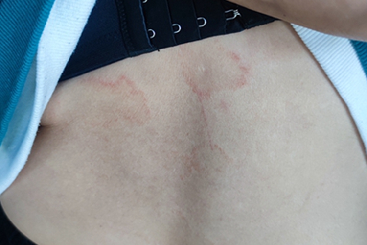 体癣背部有红色圆环形斑片图 体癣背部有红色圆环形斑片图