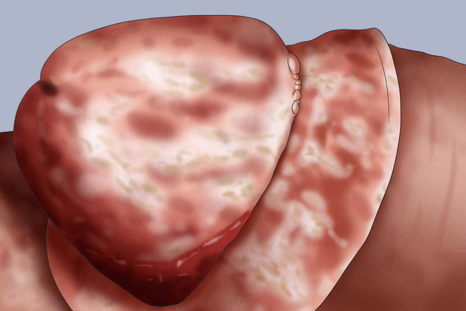 念珠菌性包皮龟头炎龟头手绘图