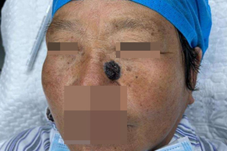 结节型基底细胞瘤鼻部结节图