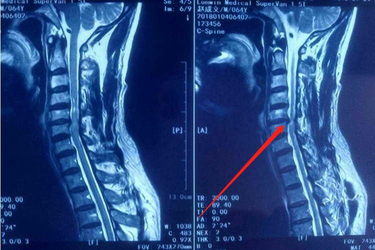脊髓型颈椎病MRI图
