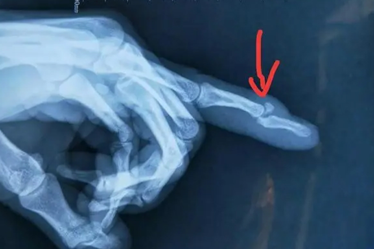 手指轻微骨折x线图