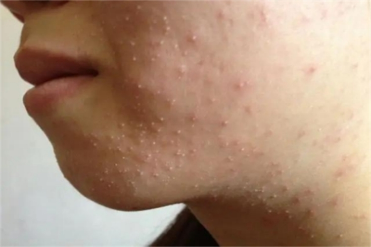 痤疮脸上有发白的小疙瘩图