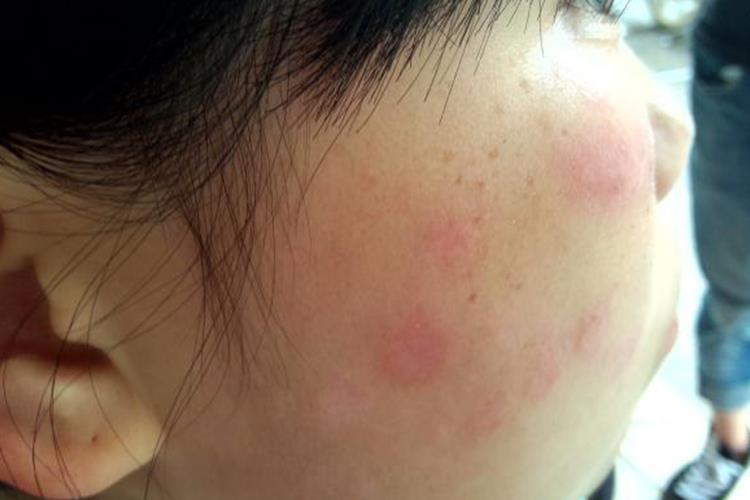 亚急性皮肤型红斑狼疮图 亚急性皮肤型红斑狼疮图