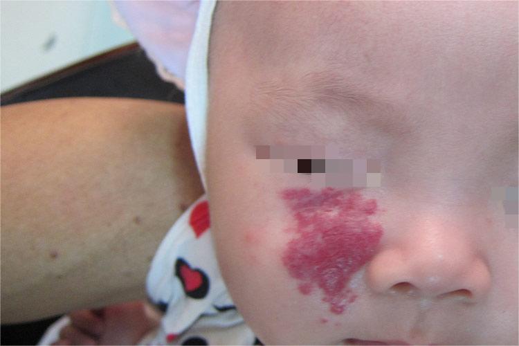 面部草莓状血管瘤图