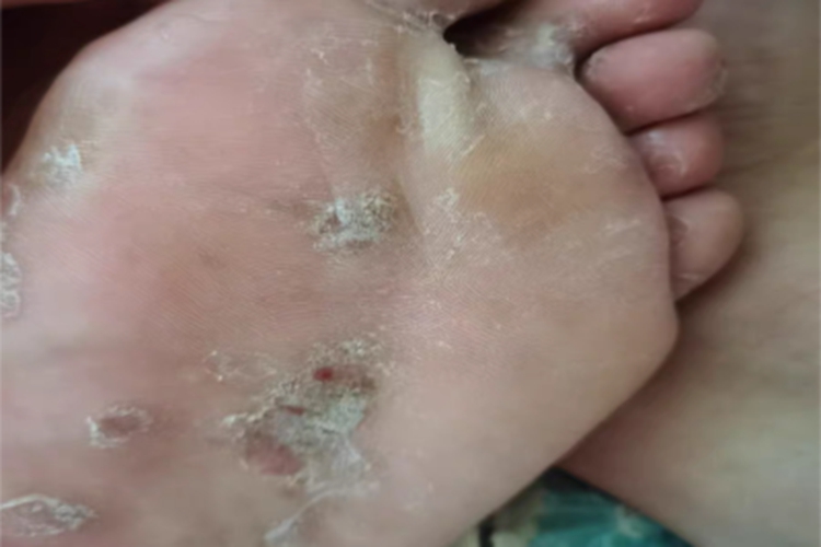 鳞屑角化型足癣脚底症状图