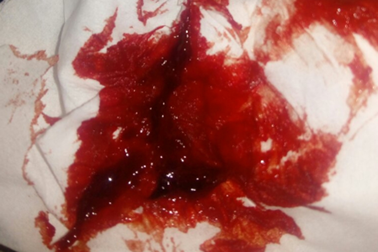 胃出血鲜红色大便图