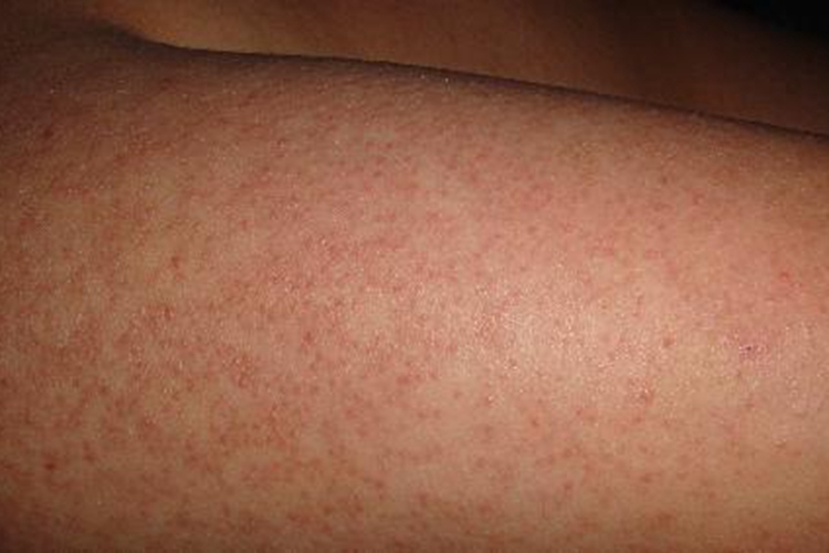 上臂严重毛周角化病图 上臂严重毛周角化病图