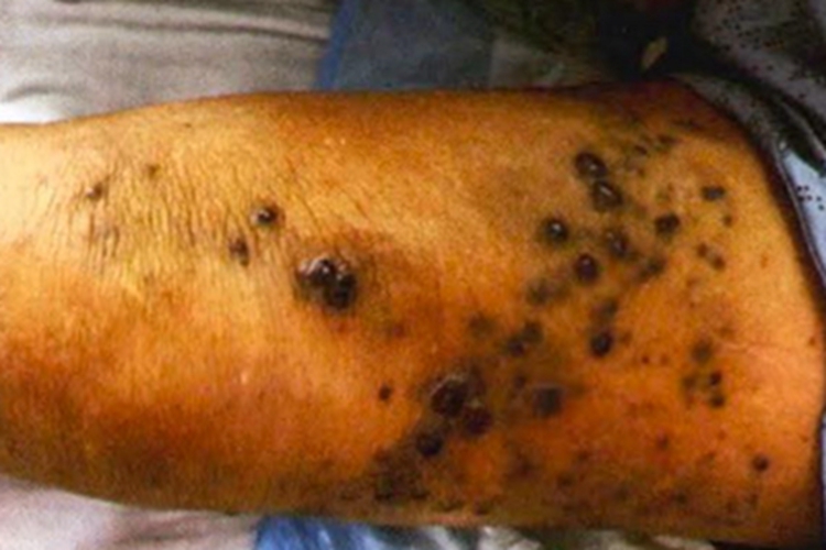 卡波西肉瘤大腿疙瘩图