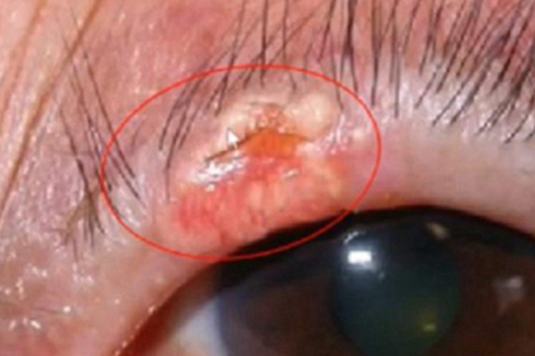 皮脂腺上皮瘤眼睑症状图
