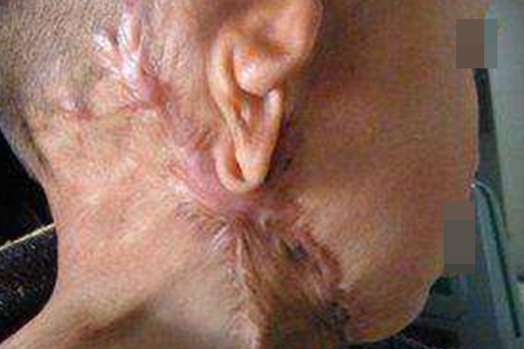 婴儿耳朵外轮廓粘连