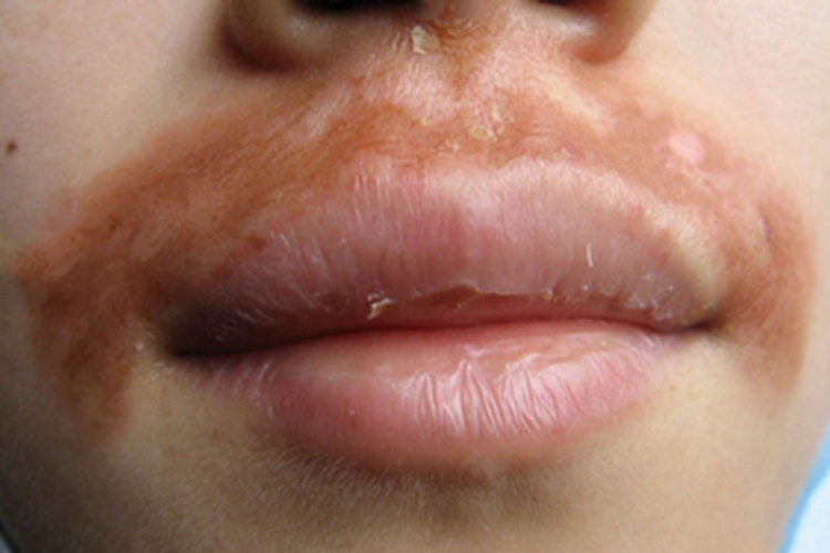 皮肤过敏红肿脱屑图