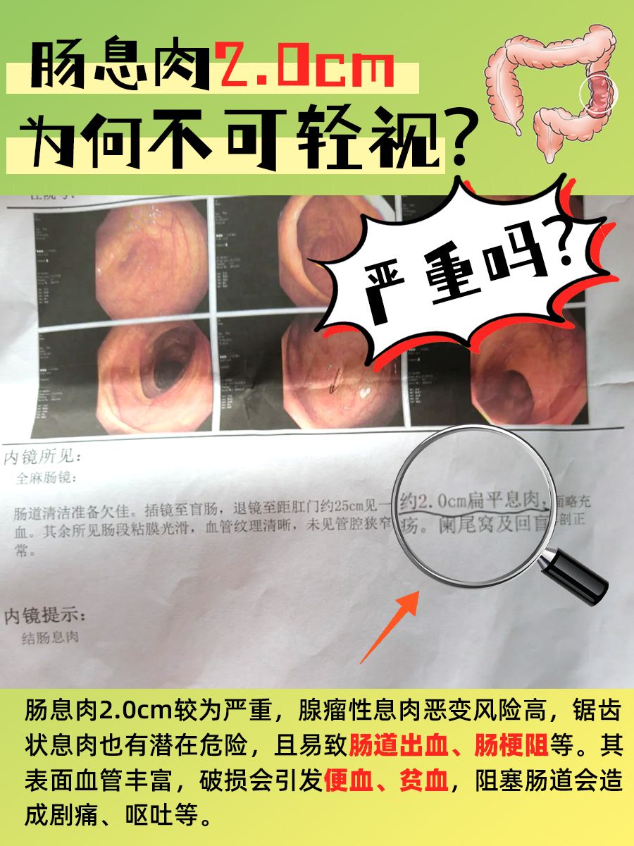 肠息肉2.0cm严重吗？为何不可轻视？