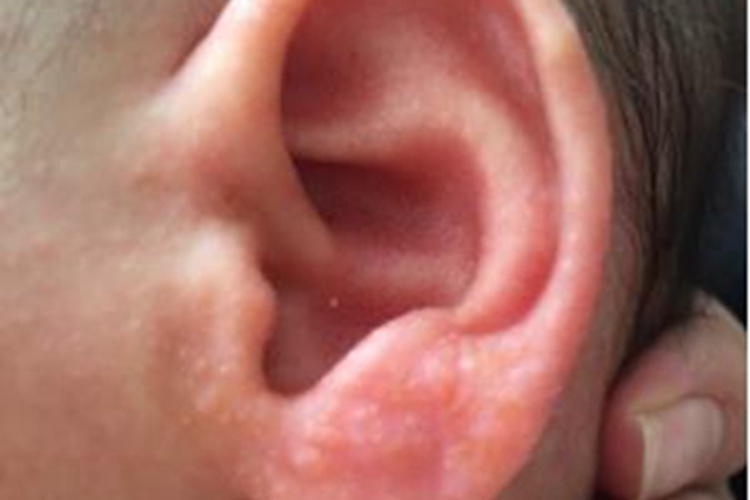 渗出型婴儿湿疹耳廓发红小疙瘩图 渗出型婴儿湿疹耳廓发红小疙瘩图