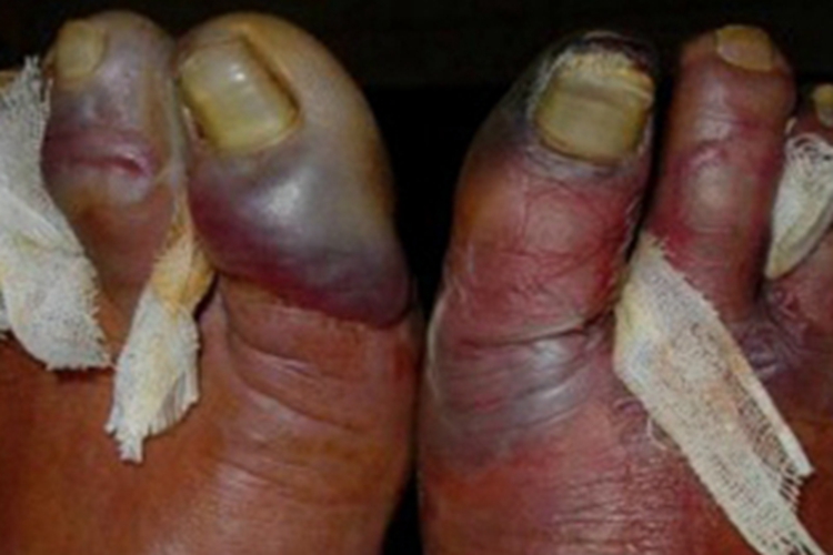 Ⅳ度冻伤红肿图