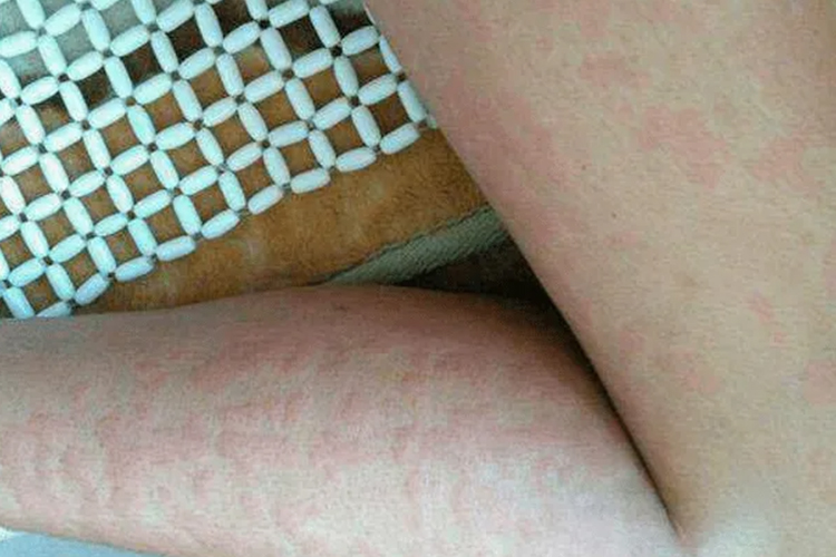 小腿接触性荨麻疹图