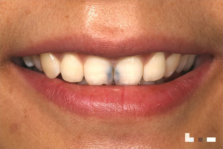 黑色牙结石图 黑色牙结石图